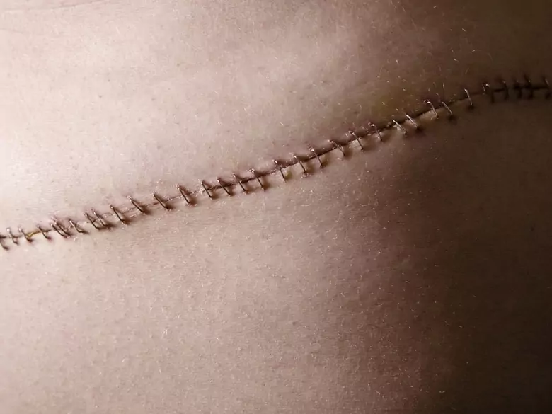 Scar creams - are they safe and effective?