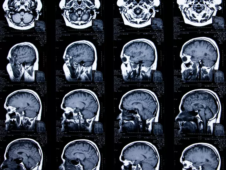 Pineal cyst - causes, symptoms, diagnosis, treatment