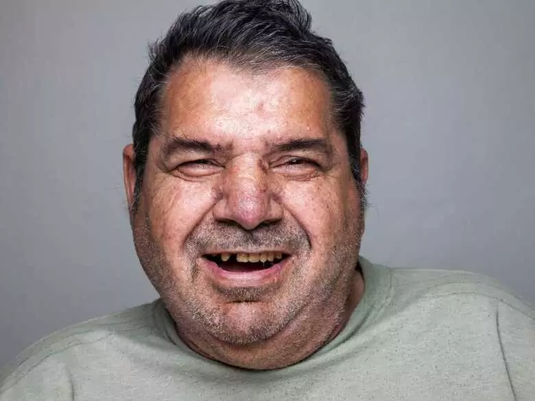 Why can obesity increase the risk of periodontal disease?