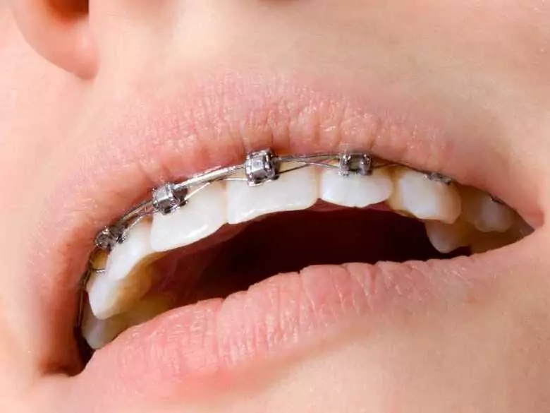 Troublesome braces