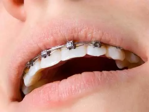 Braces - why do young people want to wear them?