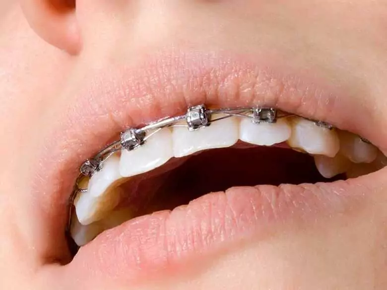 Malocclusion diagnosis