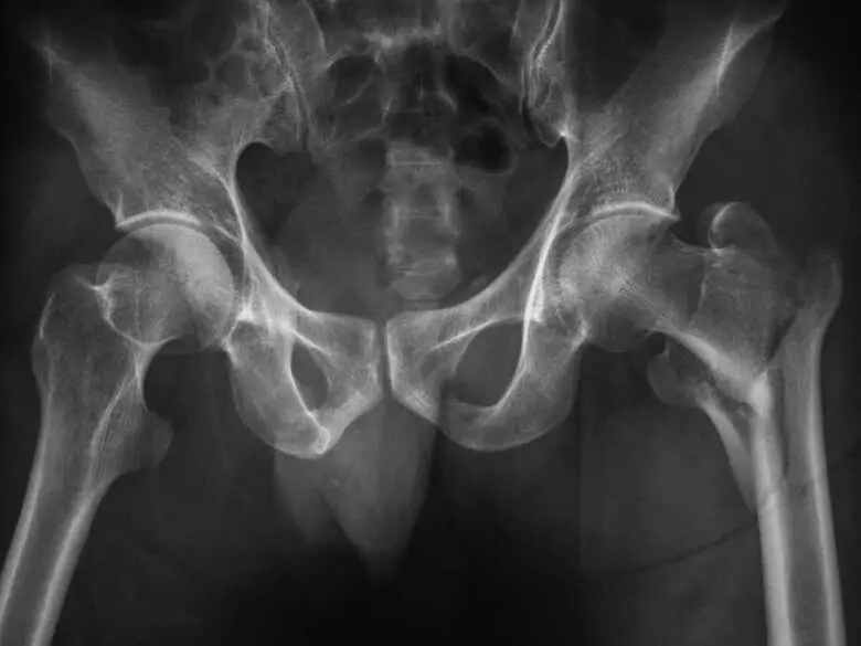 Bone fragility in peri- and postmenopausal women - causes, symptoms, diagnosis, treatment