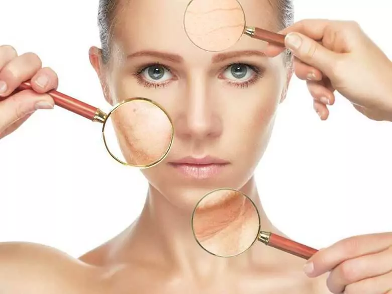 What are the reasons for the appearance of broken capillaries (so-called spider veins) on the skin?