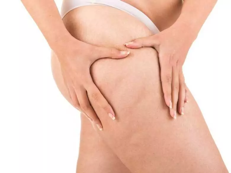 Lipodemia - 'fat leg' disease