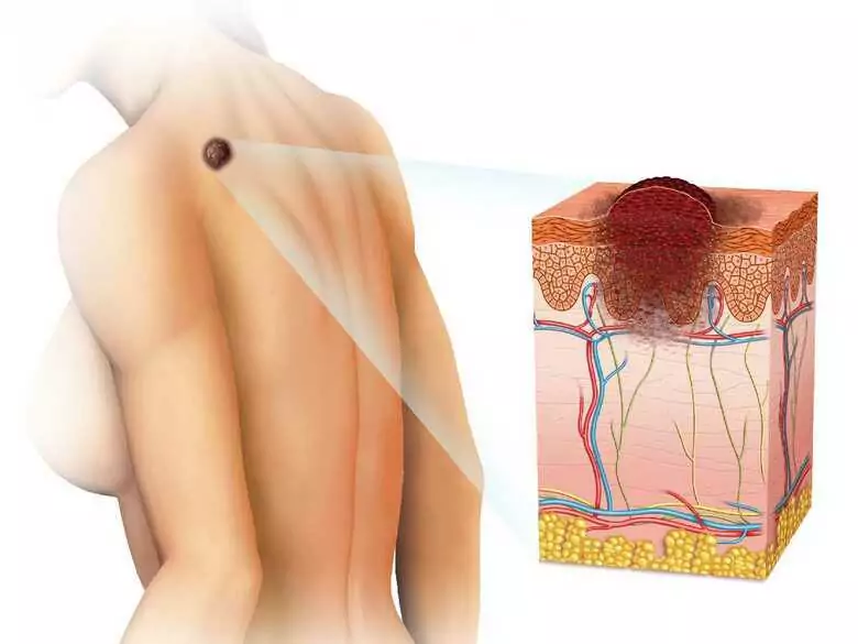 Skin cancer and precancerous conditions