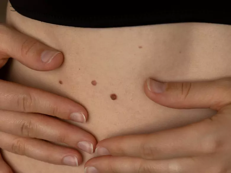 New way for scientists to detect skin cancer