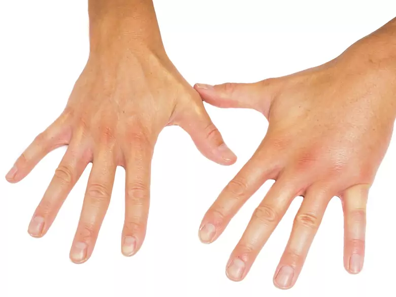 Sensory disturbance in the hand and arm - is this cause for concern?