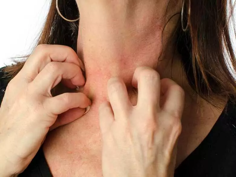 Epidemiology of contact allergy to nickel