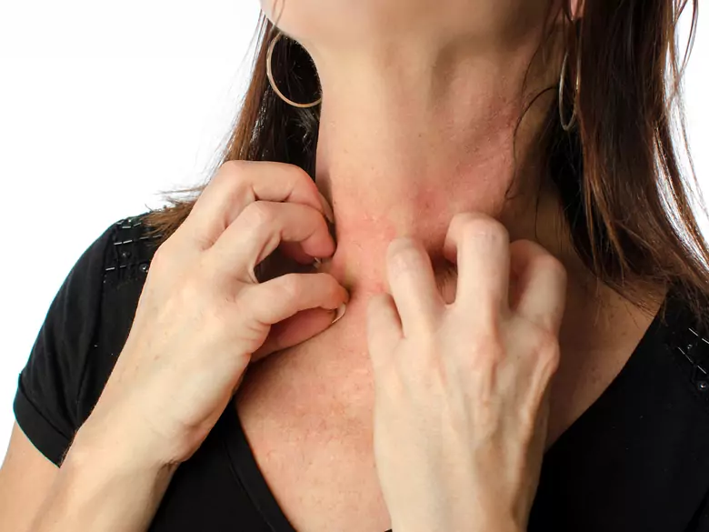 Epidemiology of contact allergy to nickel