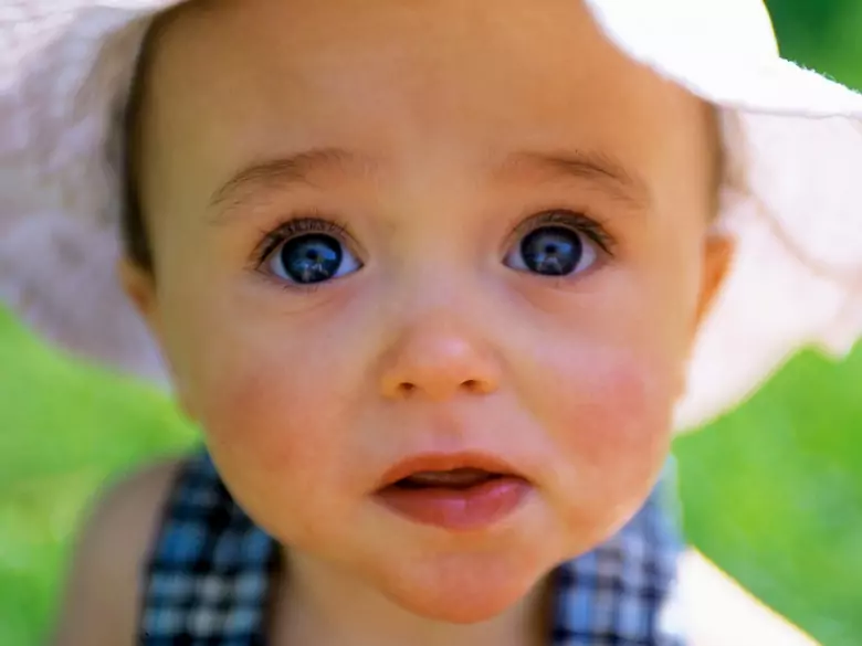 Congenital toxoplasmosis - causes, symptoms, diagnosis, treatment