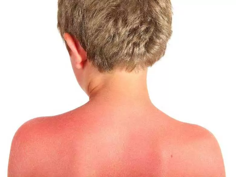 After just 30 minutes of sun exposure, your skin can be red! This is affected by the ozone layer and UV levels