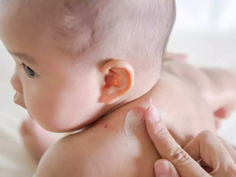 Eczema in children - effect of breastfeeding