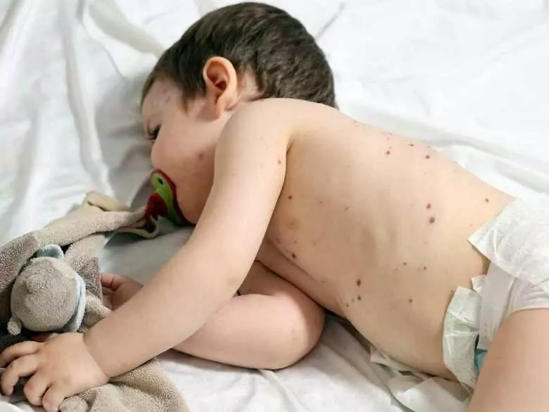 Measles outbreak in the Czech Republic
