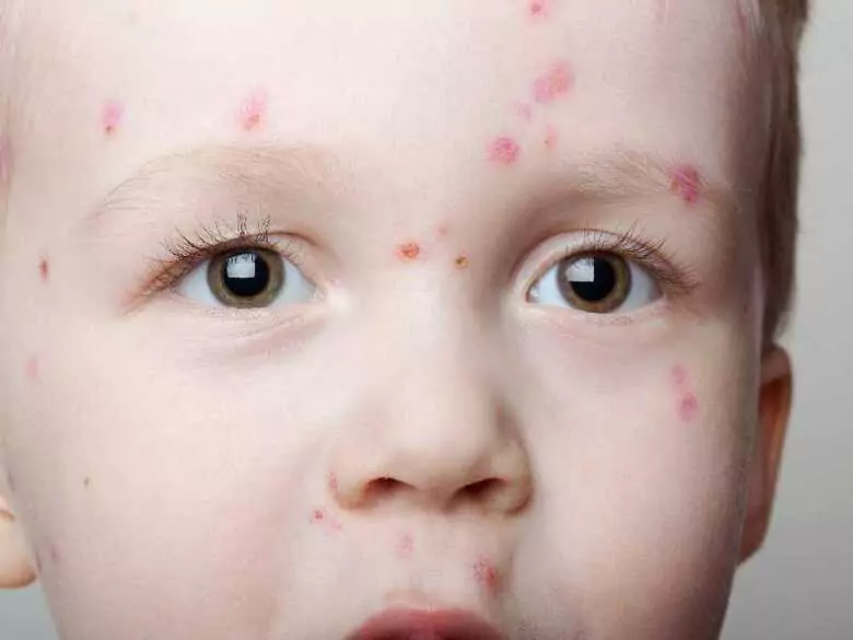 Chickenpox - infectiousness to the environment