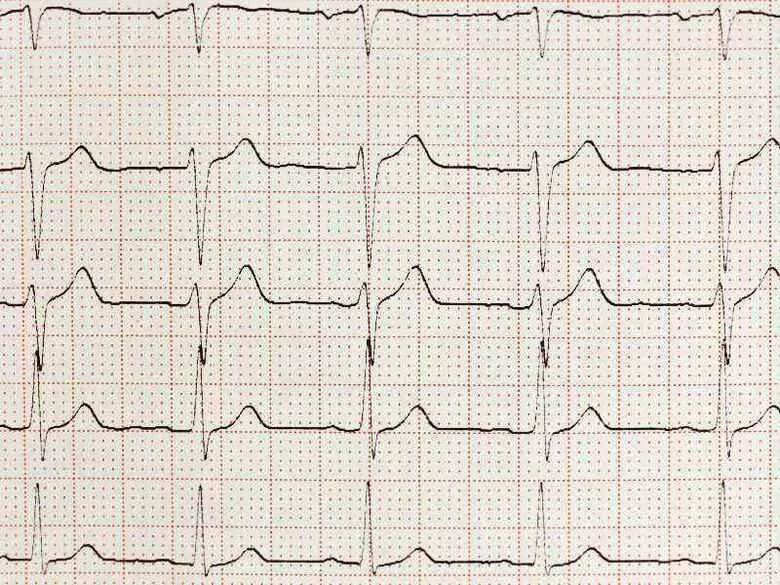 Diagnosis by ECG tests