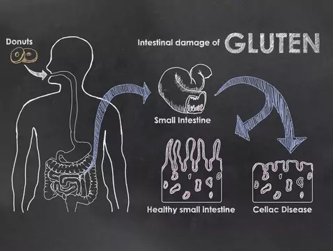People with celiac disease have a higher risk of dying prematurely
