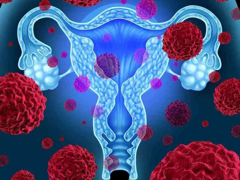 H. pyloriV virus and ovarian cancer: does the pathogen favour the cancer?