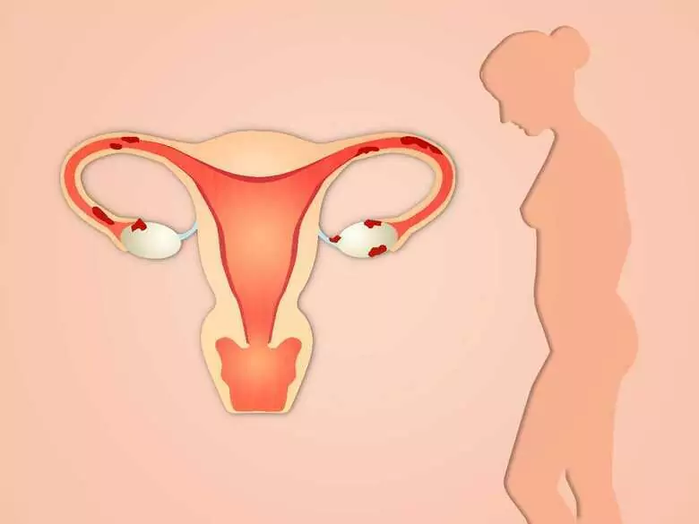 Use of thermotherapy in the treatment of painful menstruation
