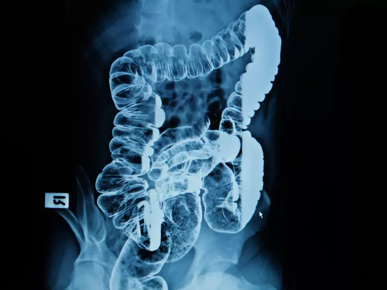 Vitamin C inhibits colon cancer!