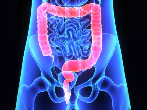 Bowel cancer - try to prevent it