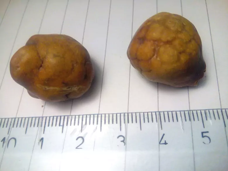 How to deal with gallstone problems?