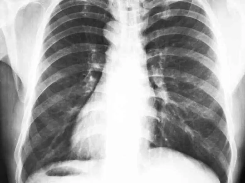 Chest X-ray in cardiology