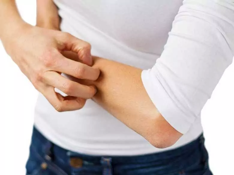 Cracked hand skin after using washing-up liquid - is it an allergy yet?