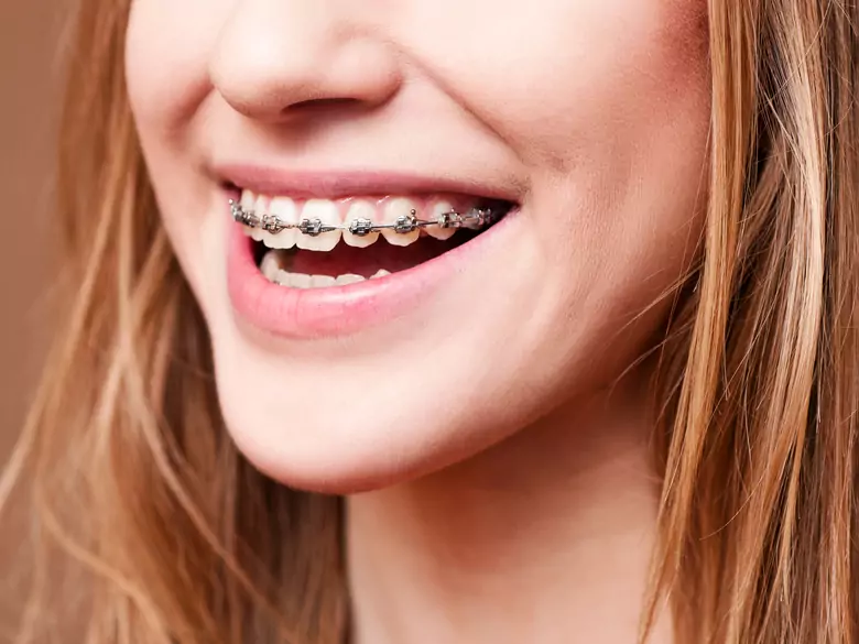 Complications following the use of braces
