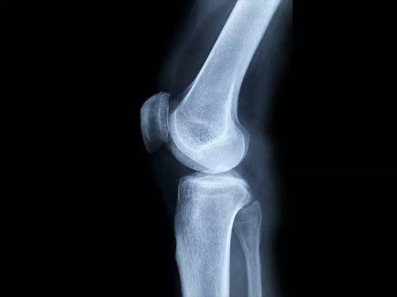 Malignant bone tumour - causes and risk factors