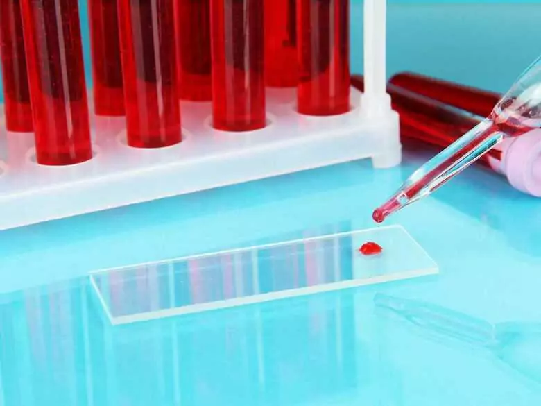 Anaemia - causes, symptoms, treatment