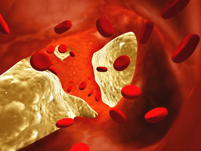 Aneurysms - a dangerous and insidious vascular disease