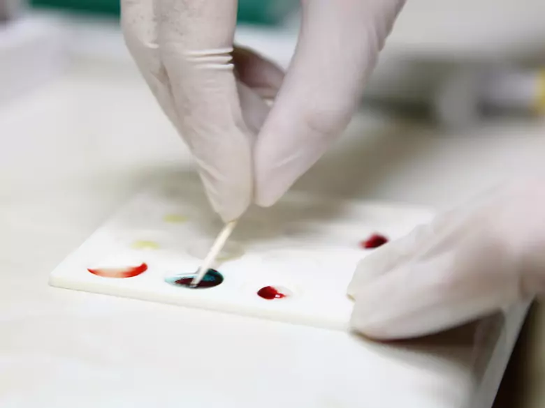 Peripheral blood smear - lymphocyte count reduction