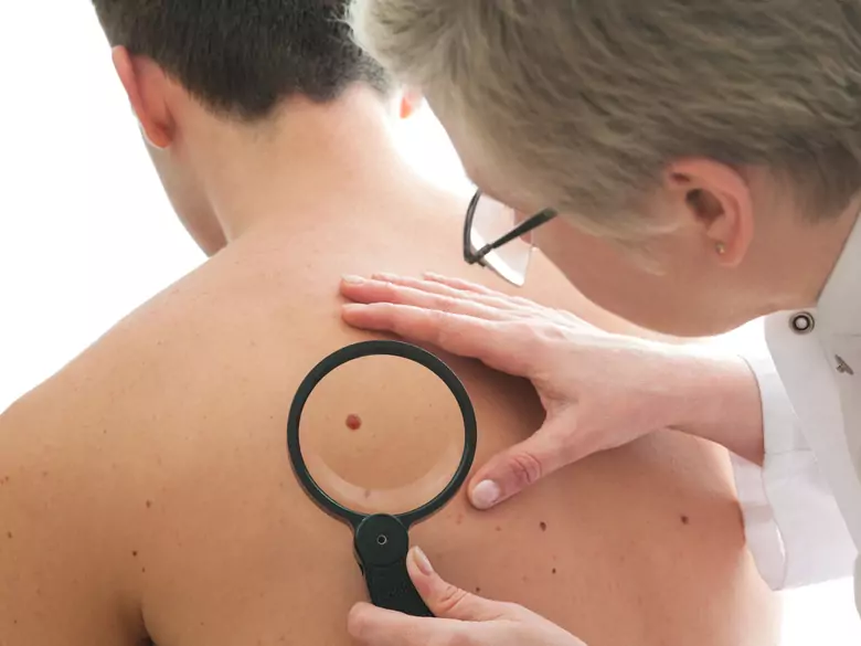 Skin cancer - causes, symptoms, diagnosis, treatment, risk of developing the disease
