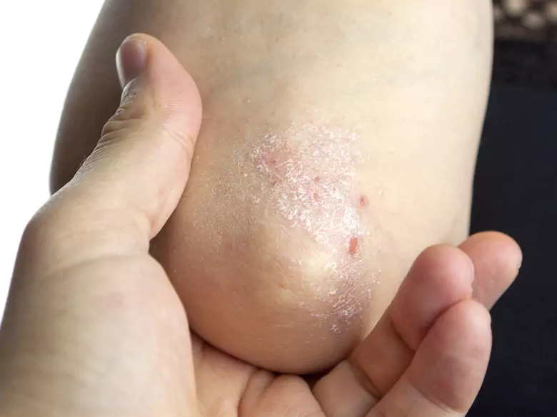 Psoriasis: which comorbidities do you have?