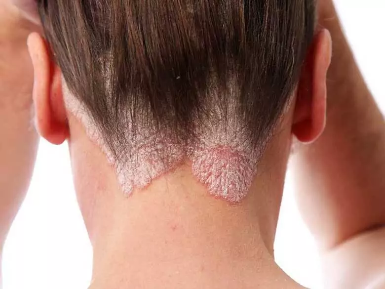Quality of life in psoriasis patients