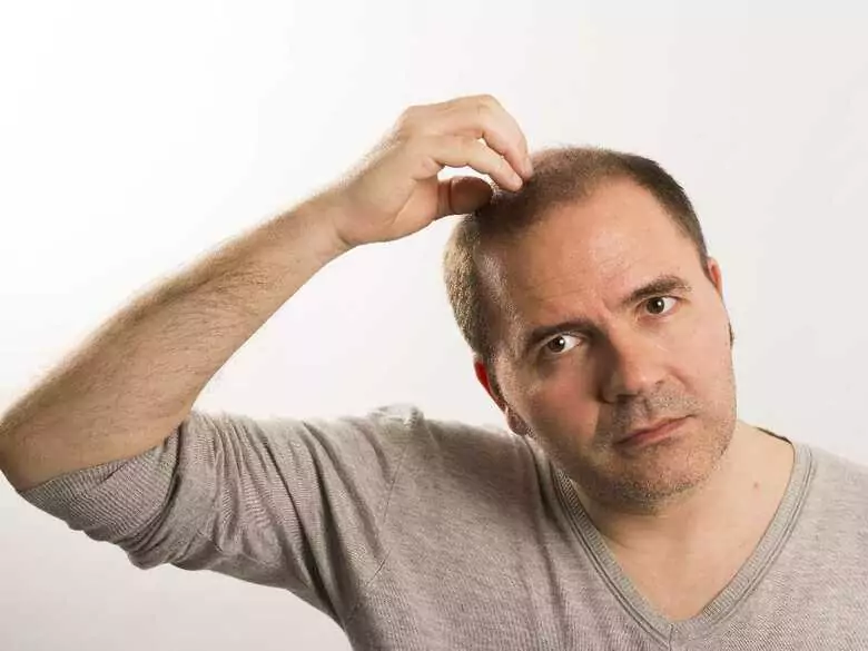 Vitamin D deficiency can promote baldness