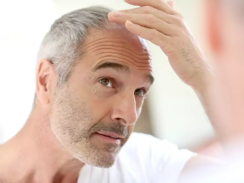 How to deal with baldness?