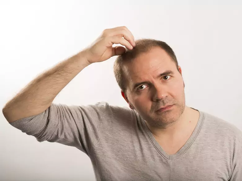 What is alopecia and how is it treated?