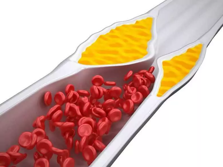 Familial hypercholesterolaemia