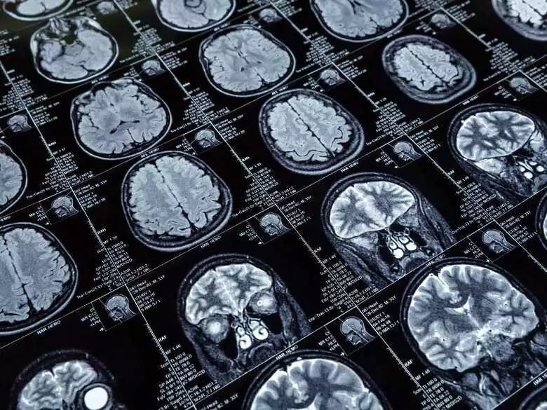 Venous sinus thrombosis of the brain