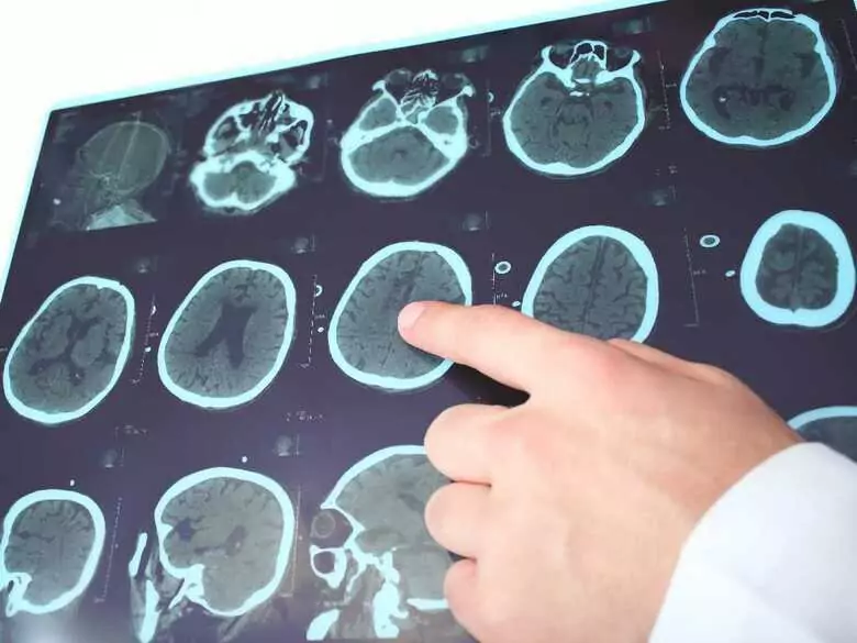 Alice in Wonderland syndrome - sounds like a fairy tale that is actually a nightmare...