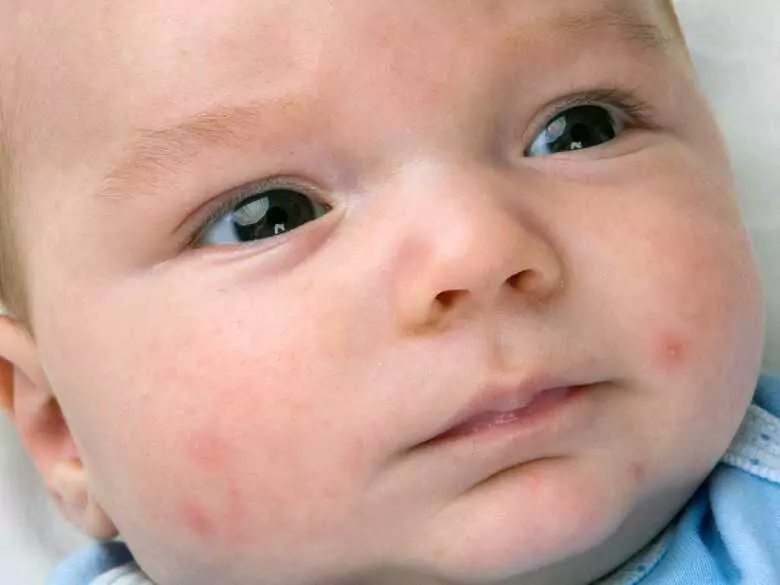 Food allergy vs rash - what should every parent know?