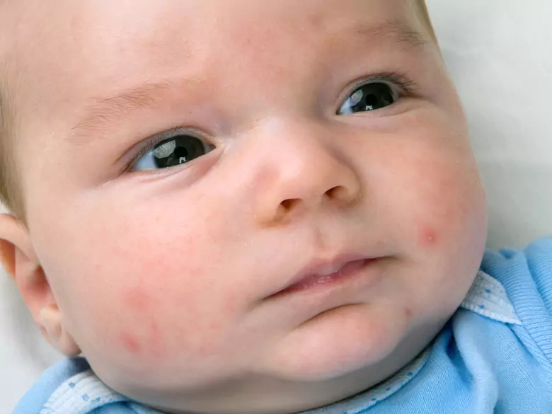 Food allergy vs rash - what should every parent know?