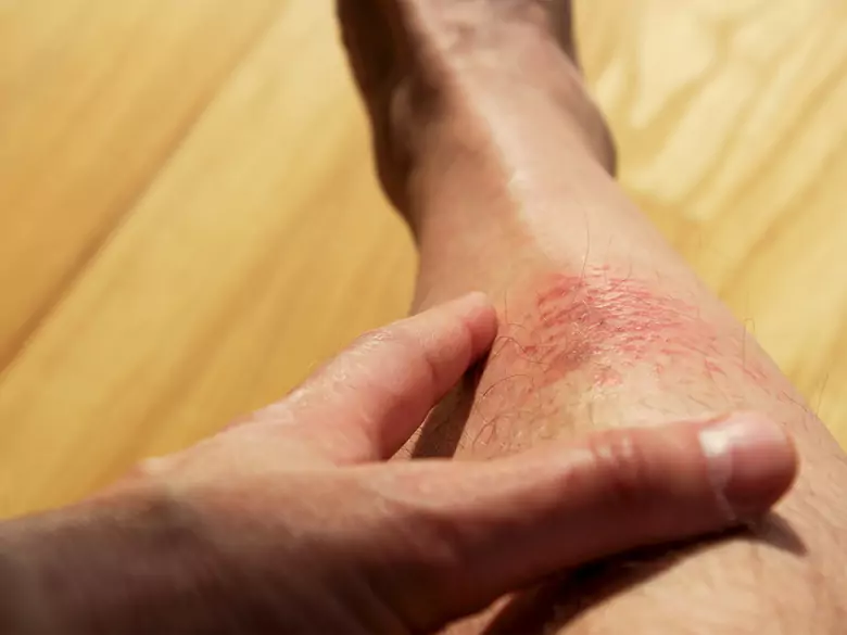 Pyoderma gangrenosum - what is it?