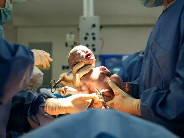 Caesarean section (cc) - indications, course and complications