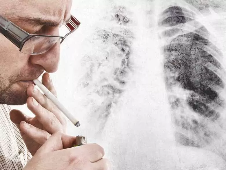 Lung cancer - why does it still kill so many of us?