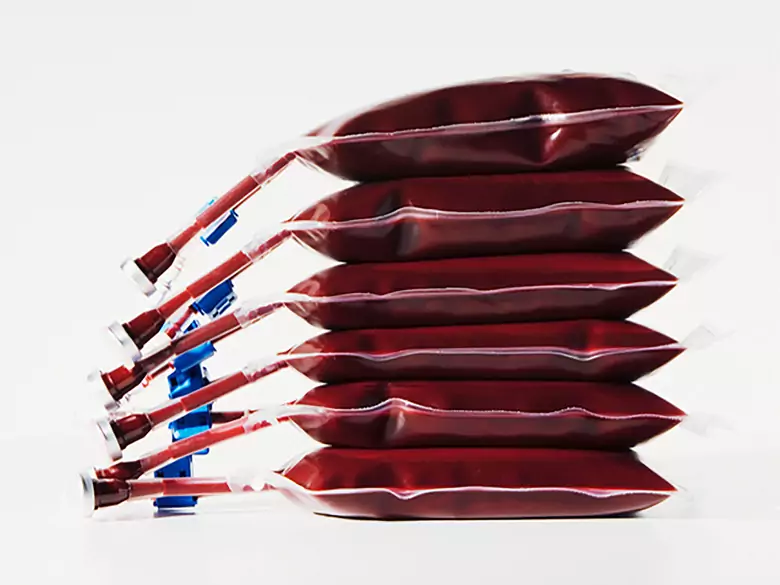 Systemic vasculitis - causes, symptoms, diagnosis, treatment