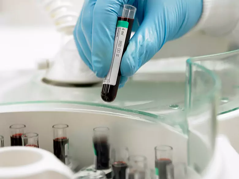 Anaemia in pregnancy - causes, symptoms, diagnosis, treatment