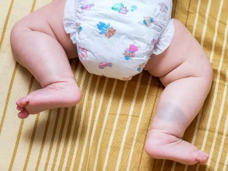 Nappy dermatitis - how to deal with this bothersome ailment?